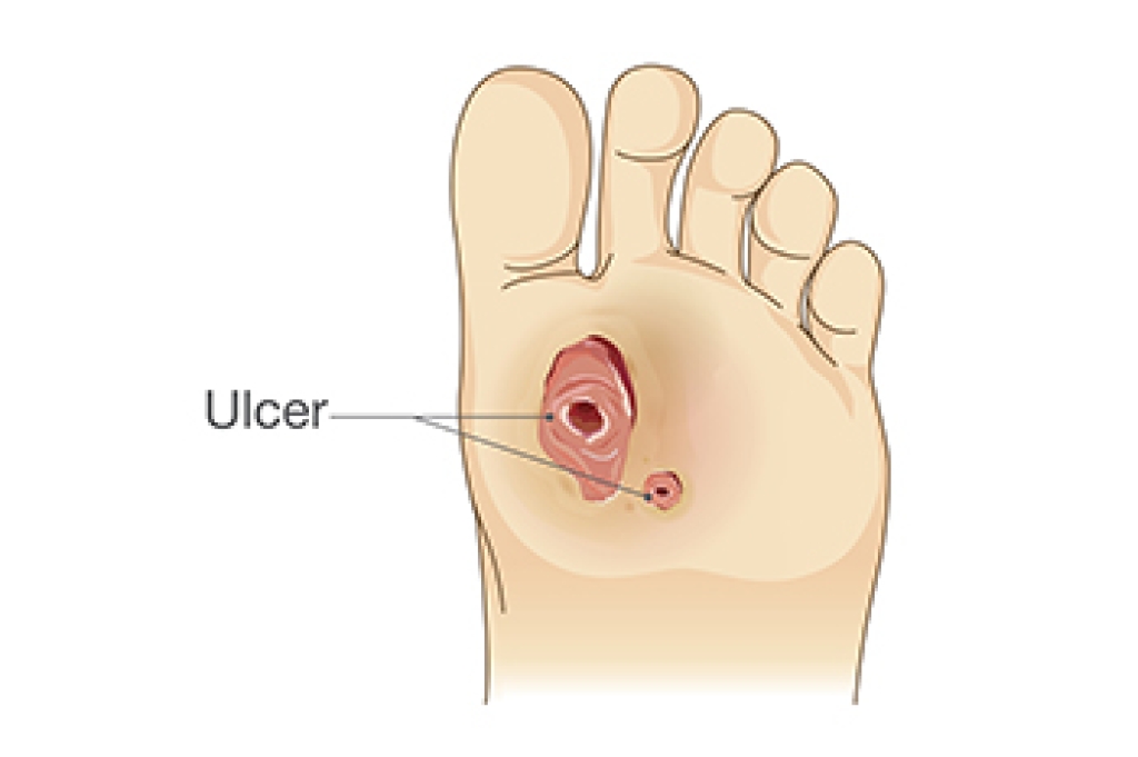 Diabetic Foot Wounds and Why Healing Is Slow