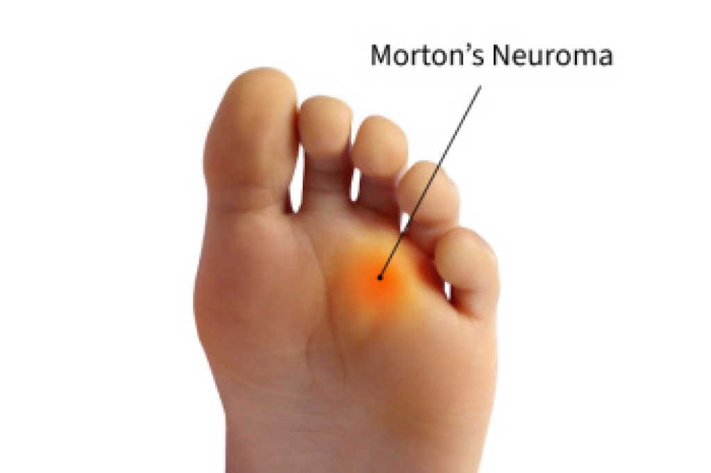 The Pain of Morton’s Neuroma