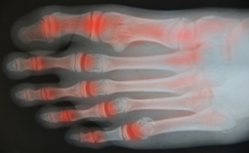Beneficial Stretches for Arthritic Feet and Ankles