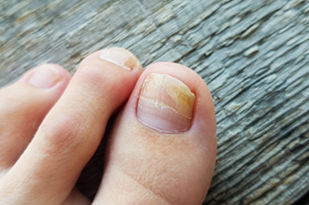Toenail Fungus and How It Develops