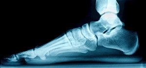 Fallen Arches and How They Affect the Feet