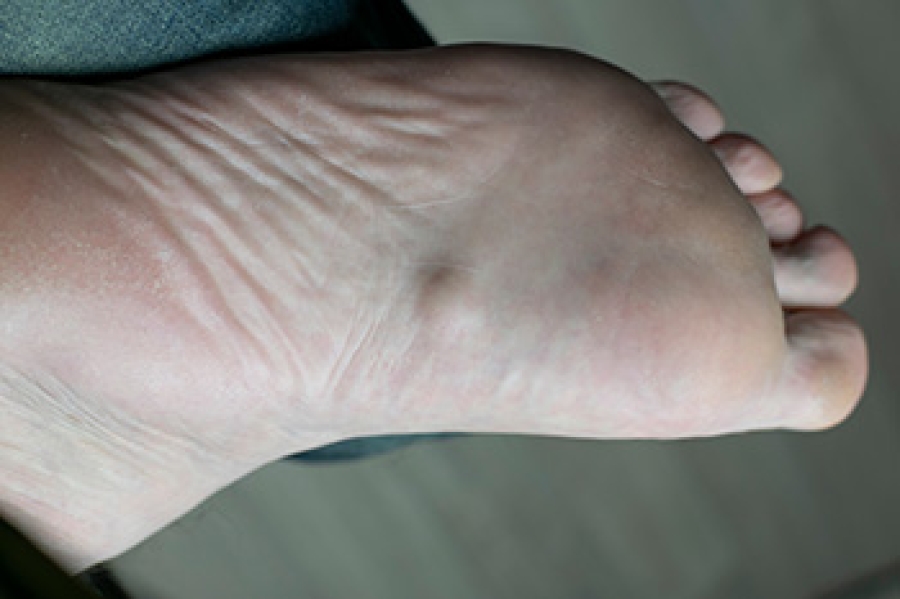 Definition And Phases Of Plantar Fibromatosis