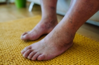 Common Diabetic Foot Problems