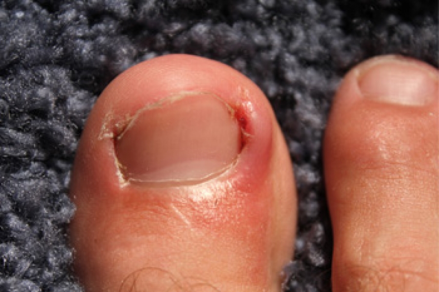 How To Avoid Ingrown Toenails