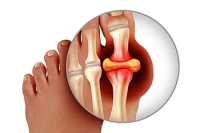 Why Gout Affects the Big Toe First